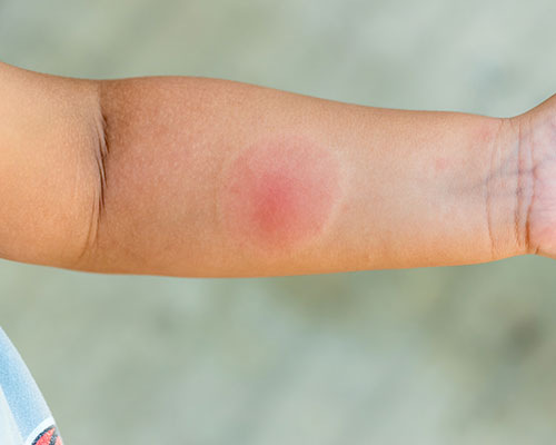 réaction cutané piqûre insecte