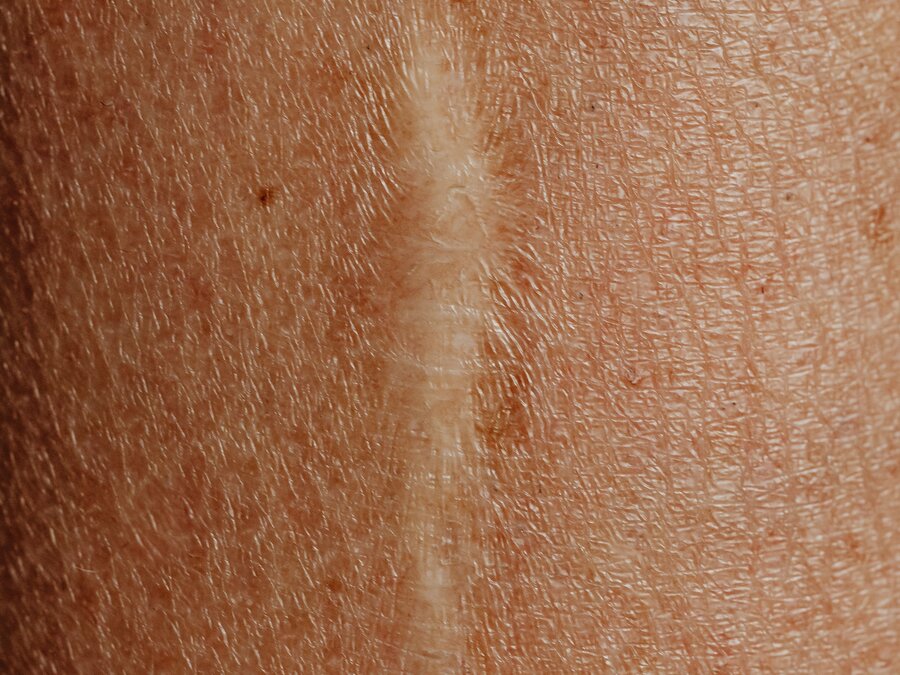 Cicatrice saine